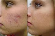 Looks More Younger by Acne treatment - Kukatpally @ Oliva Clinic,  Hyde