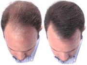 Get your Lost  Hair back  by Hair Transplant  - @ Oliva Clinic, Kukatpa