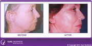 Facelift surgery