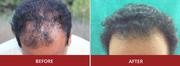 Hair Transplantation In Hyderabad