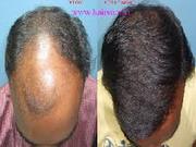 FUE Hair Transplant - hairsure