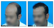 Hair loss In Hyderabad | Hair Care Treatment Centre In Hyderabad