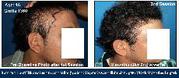 Advanced Hair Transplant & Replacement | Hair Loss | Hair Growth Treat