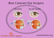 Cataract eye surgery | Cataract surgeries in Dilsukhnagar | 