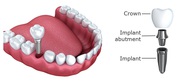 Retain Your Smile at the Best Tooth Implant Cost in India