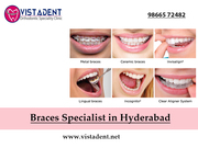  Braces | Specialist in Hyderabad | Best Dentist | VistaDent