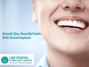 Permanent teeth in 3 days in India | LBR Dental Implants