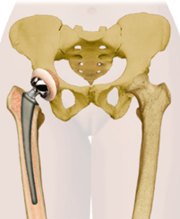 Total Hip Replacement surgery in Hyderabad - Udaiomni Hospitals