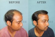 Hair transplant cost in Hyderabad  | Hitech City