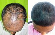 Hair Transplant cost in Hyderabad | Hairsure