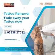 Best Advance Laser Tattoo Removal Treatment In India