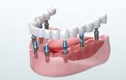 Best Dental Implants Visakhapatnam | Invisalign Treatment in vizag | T