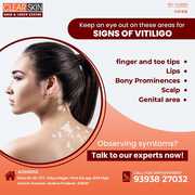 Mesotherapy hair Treatment  in bangalore