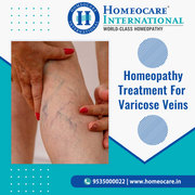 Homeopathy Treatment for Varicose Veins - Homeocare International