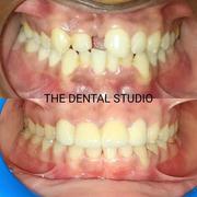 Best dental clinic near me | Best Invisalign treatment near me