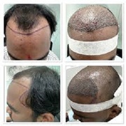 Hair Transplantation in Kondapur