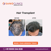 Hair Transplantation in Hitech City