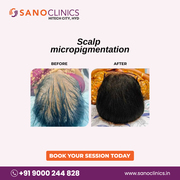 Best Hair Transplantation in Kondapur