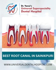Top Reasons to Choose a Root Canal Specialist Over a General Dentist